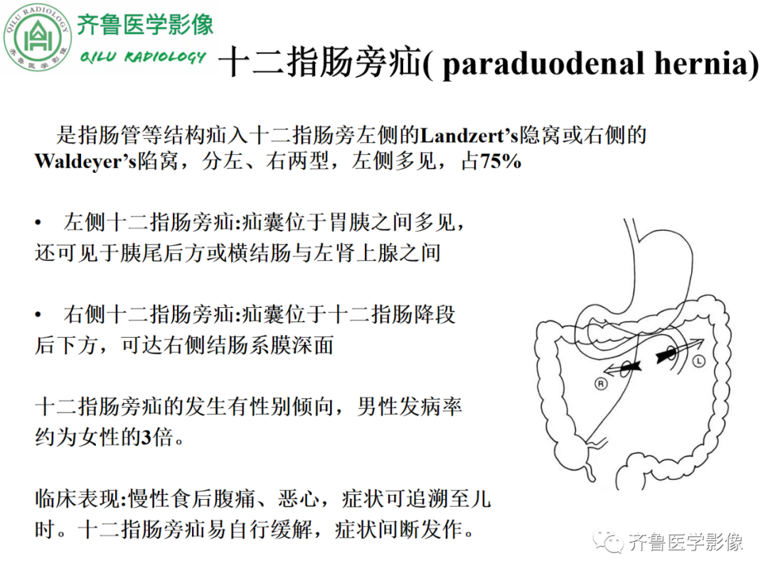 影像PPT - 【PPT】腹内疝-29