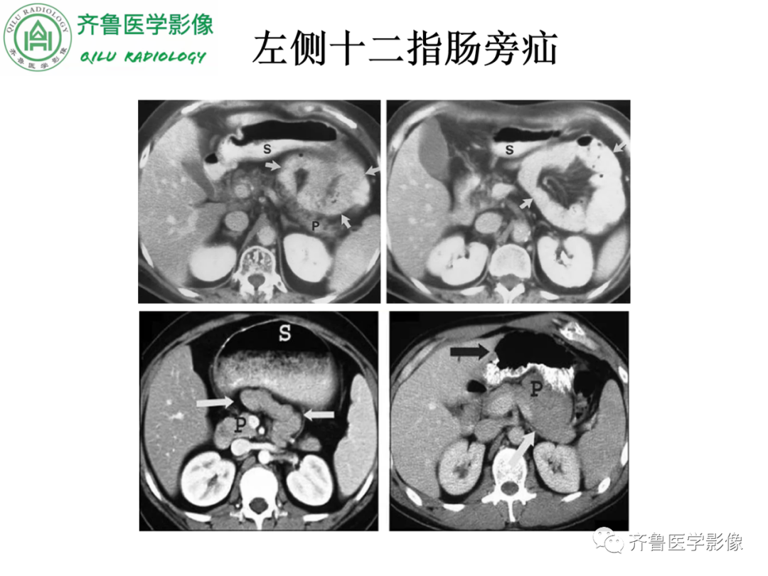 影像PPT - 【PPT】腹内疝-32