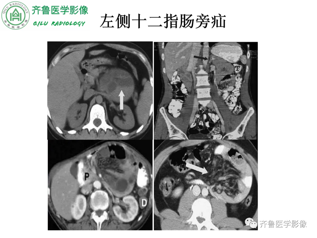 影像PPT - 【PPT】腹内疝-33