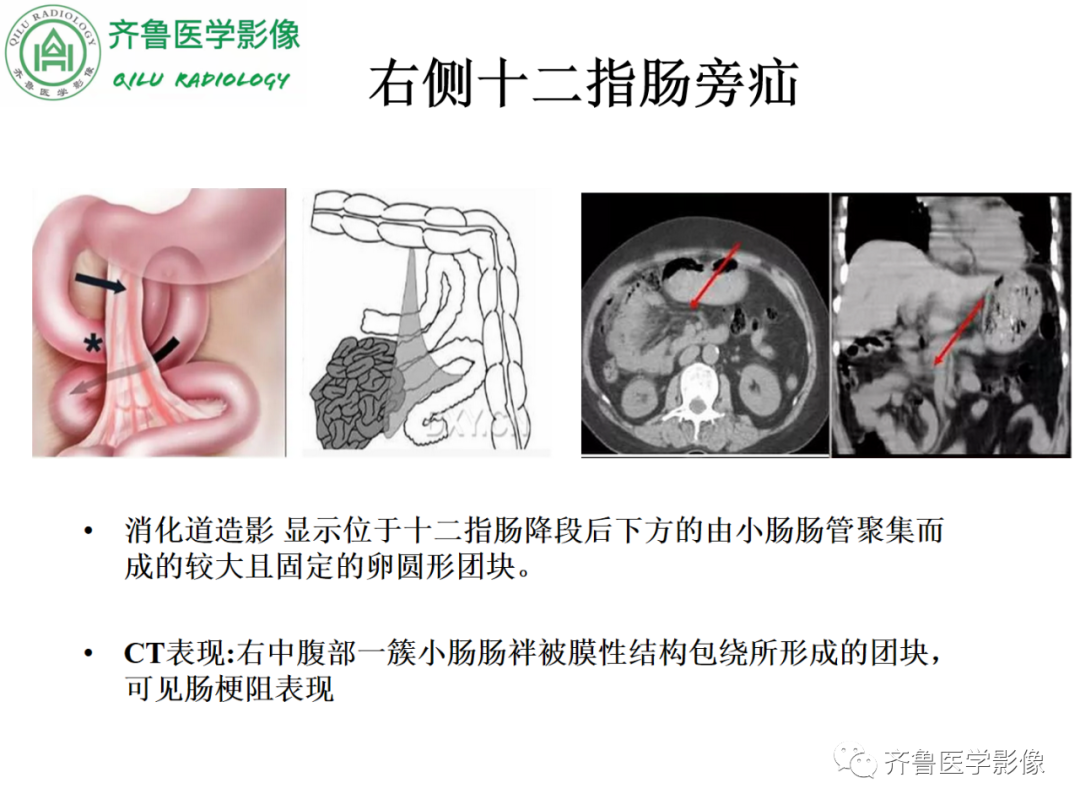 影像PPT - 【PPT】腹内疝-34