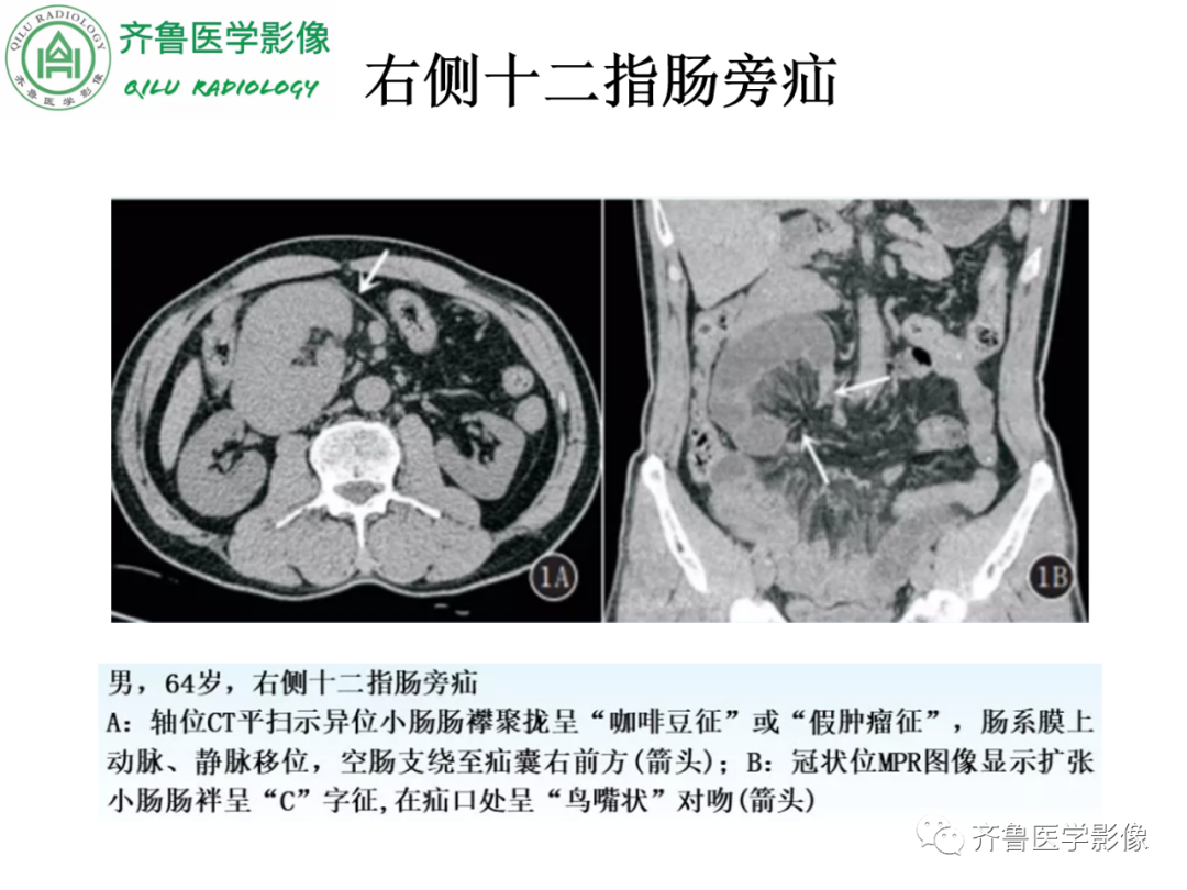 影像PPT - 【PPT】腹内疝-36