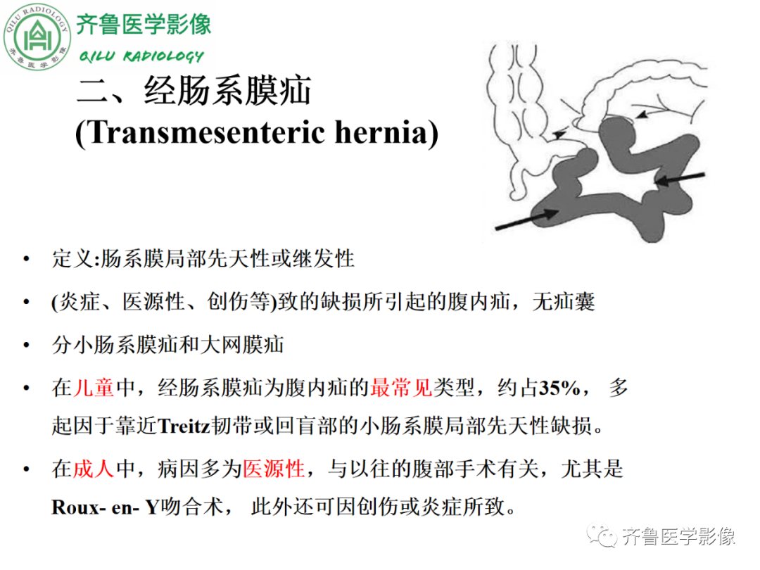 影像PPT - 【PPT】腹内疝-37