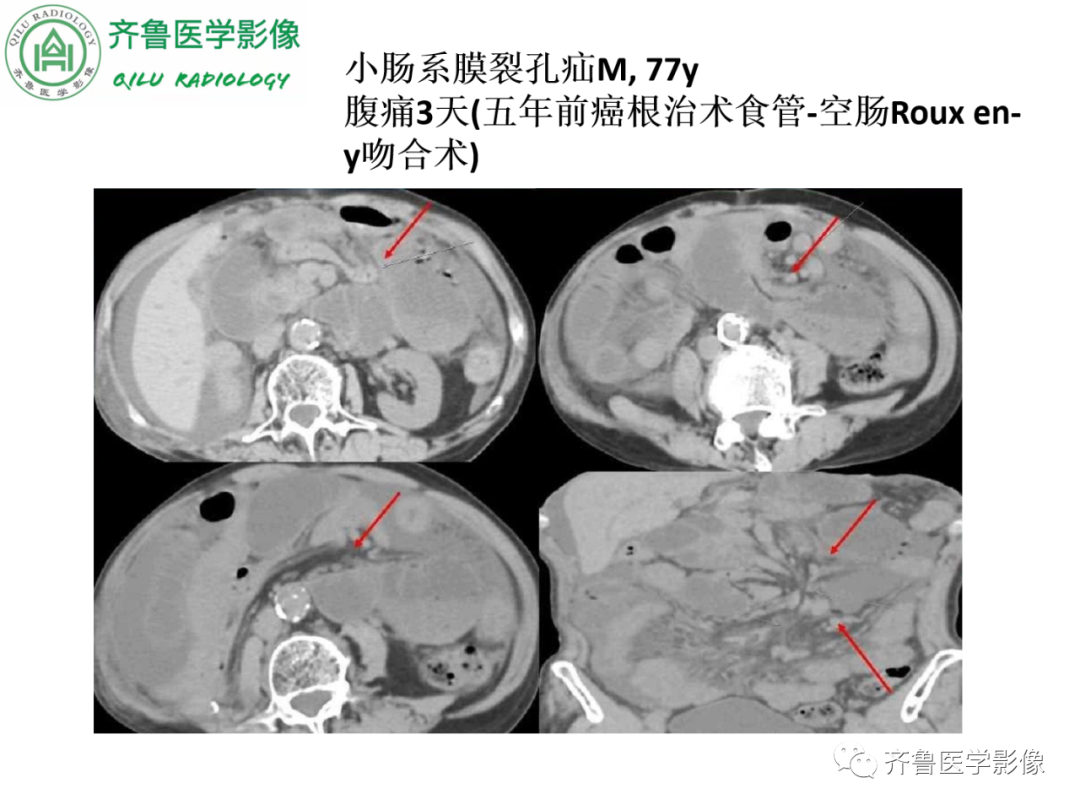 影像PPT - 【PPT】腹内疝-39