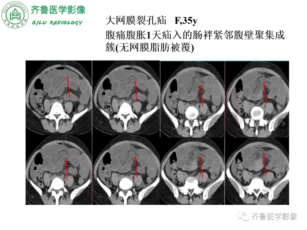 影像PPT - 【PPT】腹内疝-40