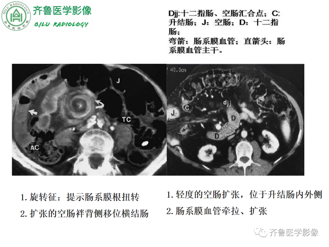 影像PPT - 【PPT】腹内疝-41
