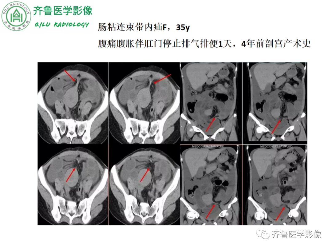 影像PPT - 【PPT】腹内疝-43