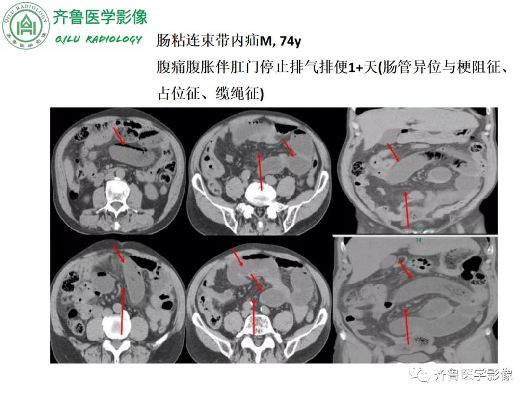 影像PPT - 【PPT】腹内疝-44