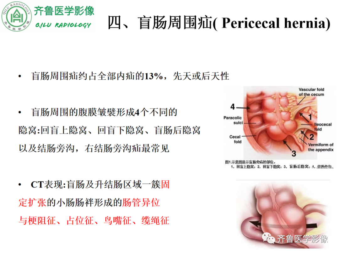 影像PPT - 【PPT】腹内疝-45