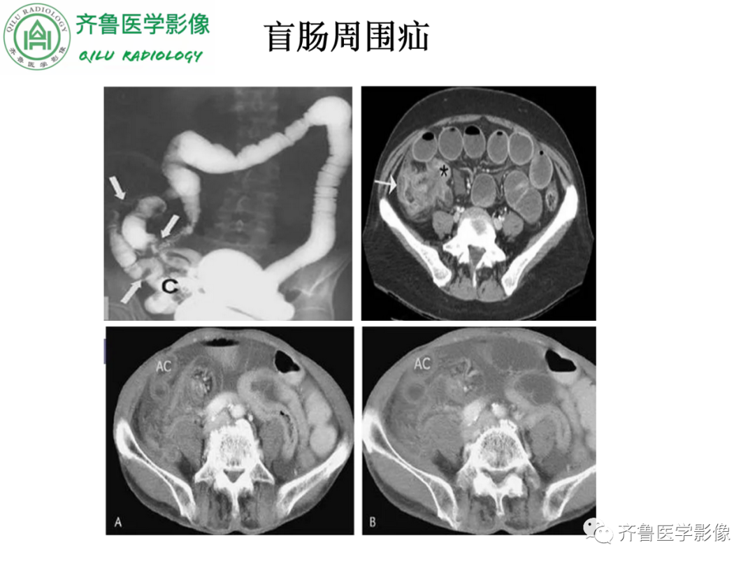 影像PPT - 【PPT】腹内疝-46