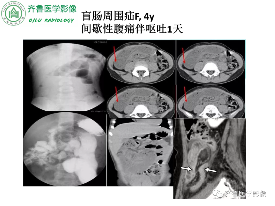 影像PPT - 【PPT】腹内疝-47