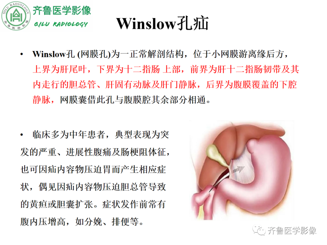 影像PPT - 【PPT】腹内疝-49