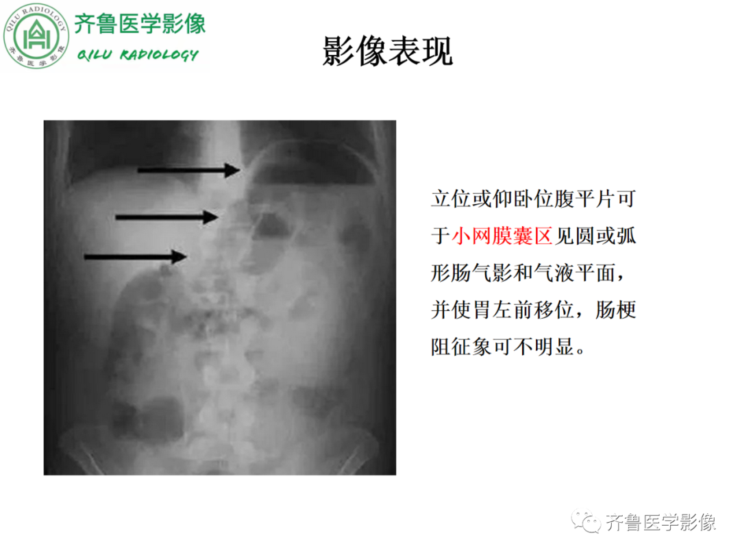 影像PPT - 【PPT】腹内疝-50