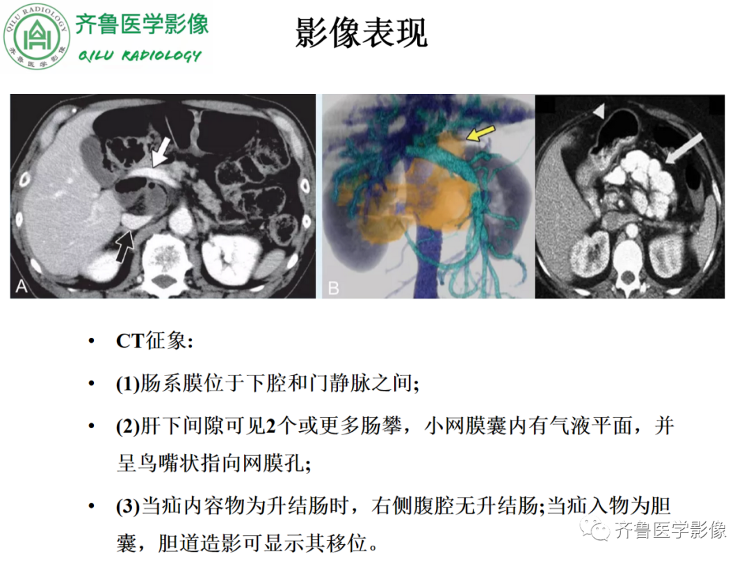 影像PPT - 【PPT】腹内疝-51