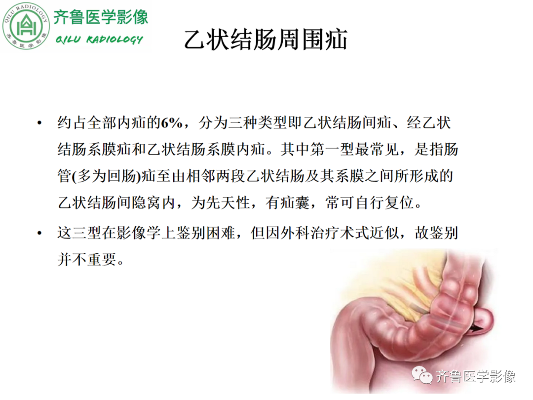 影像PPT - 【PPT】腹内疝-52