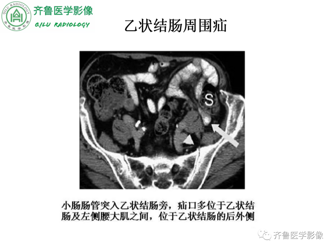影像PPT - 【PPT】腹内疝-54
