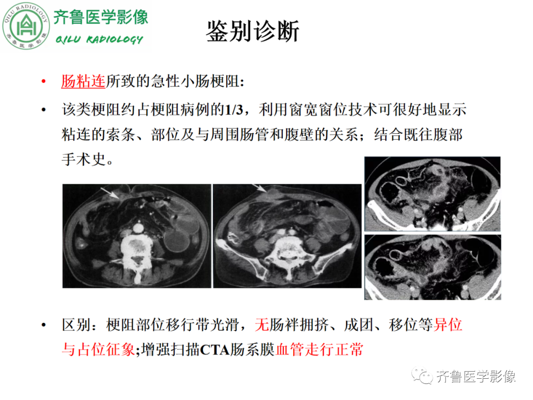 影像PPT - 【PPT】腹内疝-55