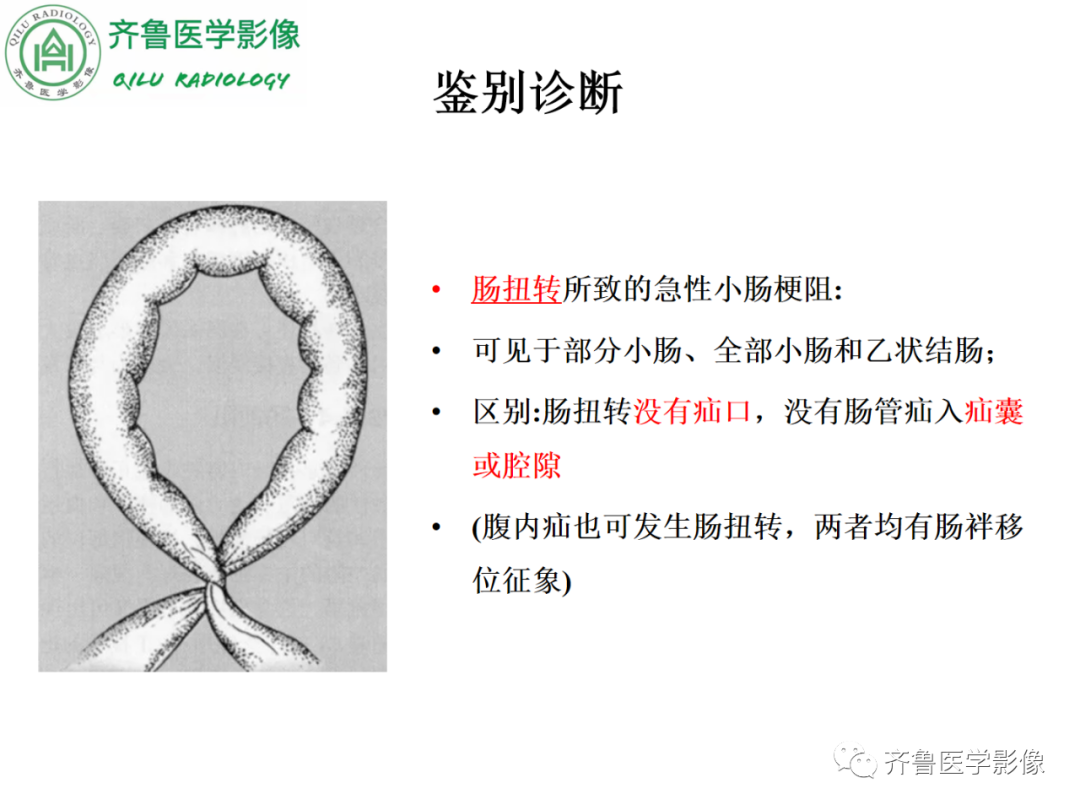 影像PPT - 【PPT】腹内疝-56
