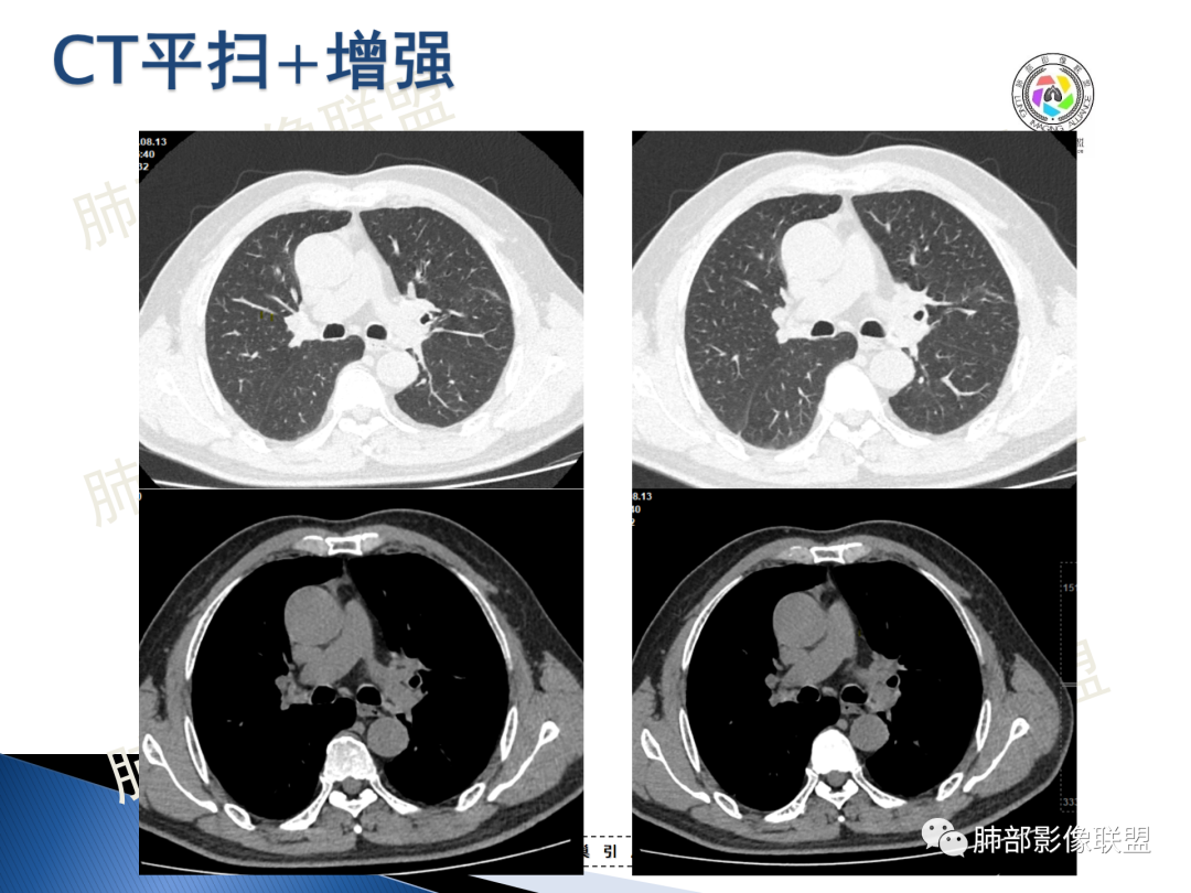 影像PPT - 【病例】“月牙铲”的绝杀—肺腺癌1例CT影像-4 影像PPT - 【病例】“月牙铲”的绝杀—肺腺癌1例CT影像-4