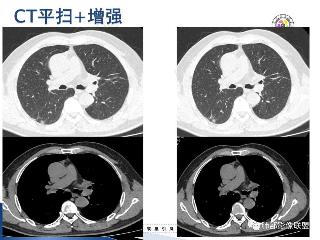 影像PPT - 【病例】“月牙铲”的绝杀—肺腺癌1例CT影像-5 影像PPT - 【病例】“月牙铲”的绝杀—肺腺癌1例CT影像-5