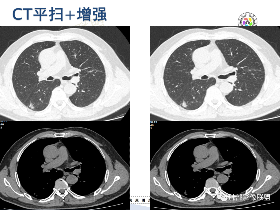 影像PPT - 【病例】“月牙铲”的绝杀—肺腺癌1例CT影像-6 影像PPT - 【病例】“月牙铲”的绝杀—肺腺癌1例CT影像-6