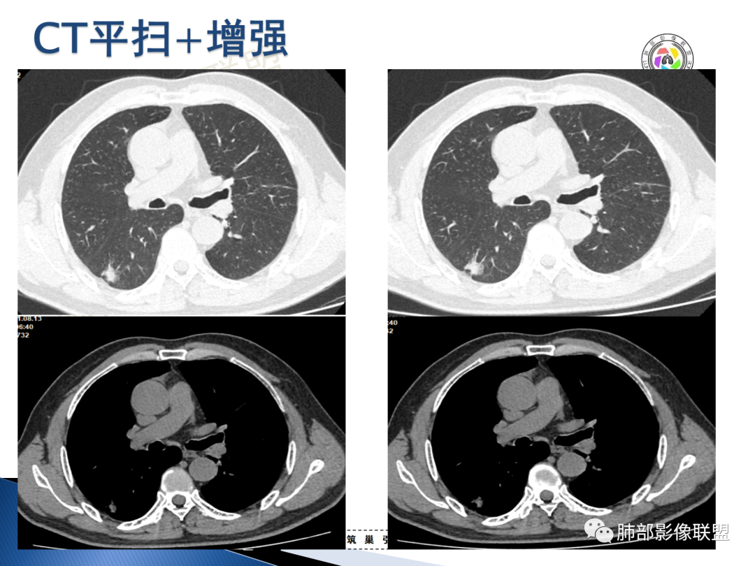影像PPT - 【病例】“月牙铲”的绝杀—肺腺癌1例CT影像-7 影像PPT - 【病例】“月牙铲”的绝杀—肺腺癌1例CT影像-7
