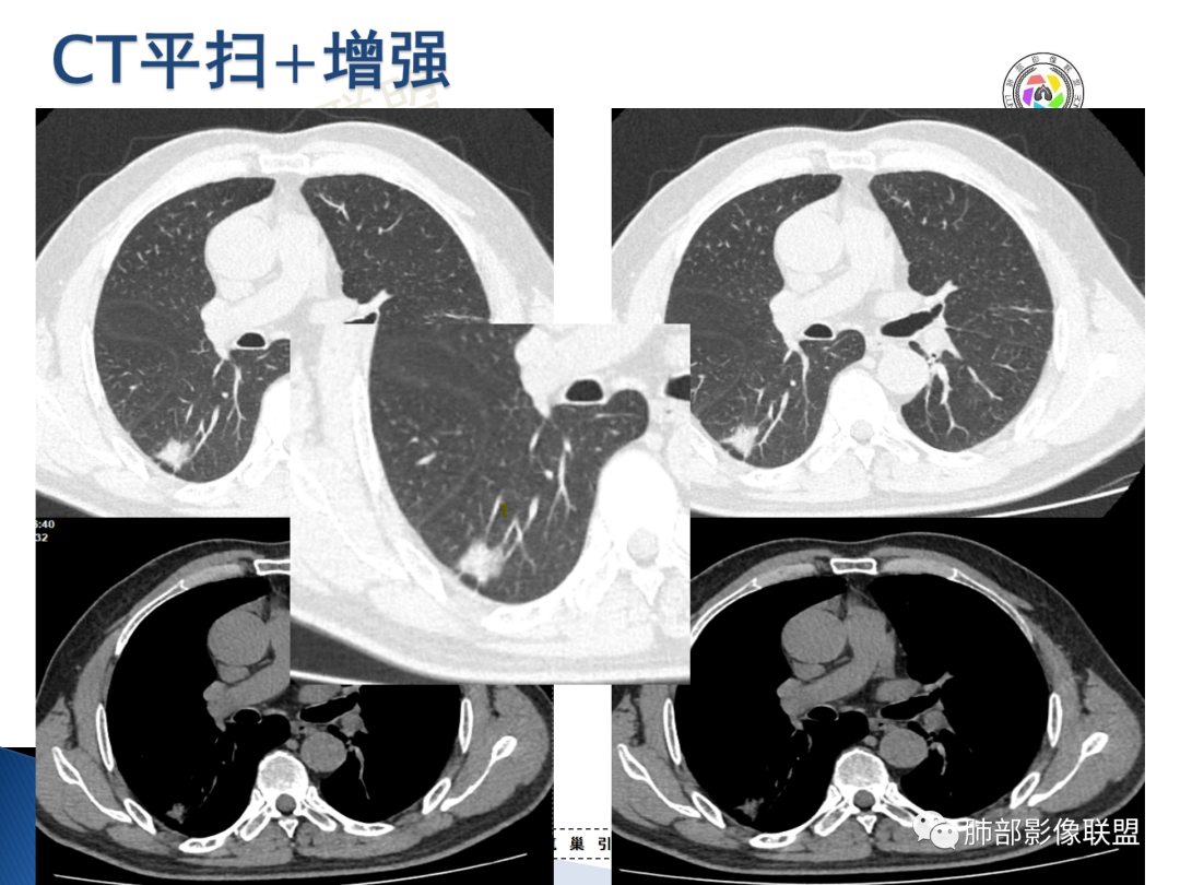 影像PPT - 【病例】“月牙铲”的绝杀—肺腺癌1例CT影像-9 影像PPT - 【病例】“月牙铲”的绝杀—肺腺癌1例CT影像-9