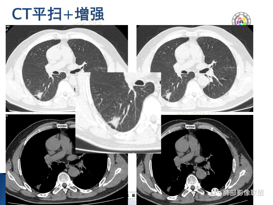 影像PPT - 【病例】“月牙铲”的绝杀—肺腺癌1例CT影像-10 影像PPT - 【病例】“月牙铲”的绝杀—肺腺癌1例CT影像-10