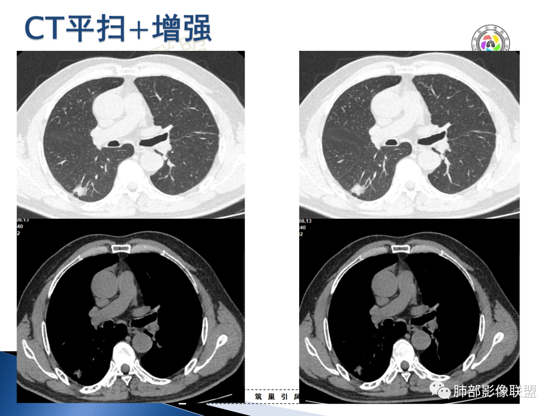 影像PPT - 【病例】“月牙铲”的绝杀—肺腺癌1例CT影像-8 影像PPT - 【病例】“月牙铲”的绝杀—肺腺癌1例CT影像-8