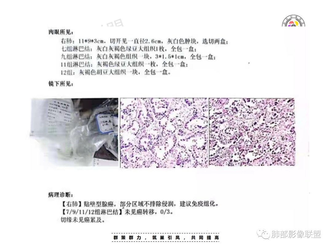 影像PPT - 【病例】“月牙铲”的绝杀—肺腺癌1例CT影像-26 影像PPT - 【病例】“月牙铲”的绝杀—肺腺癌1例CT影像-26