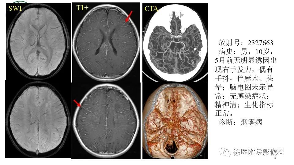 影像PPT - 【PPT】烟雾病和烟雾综合征-2