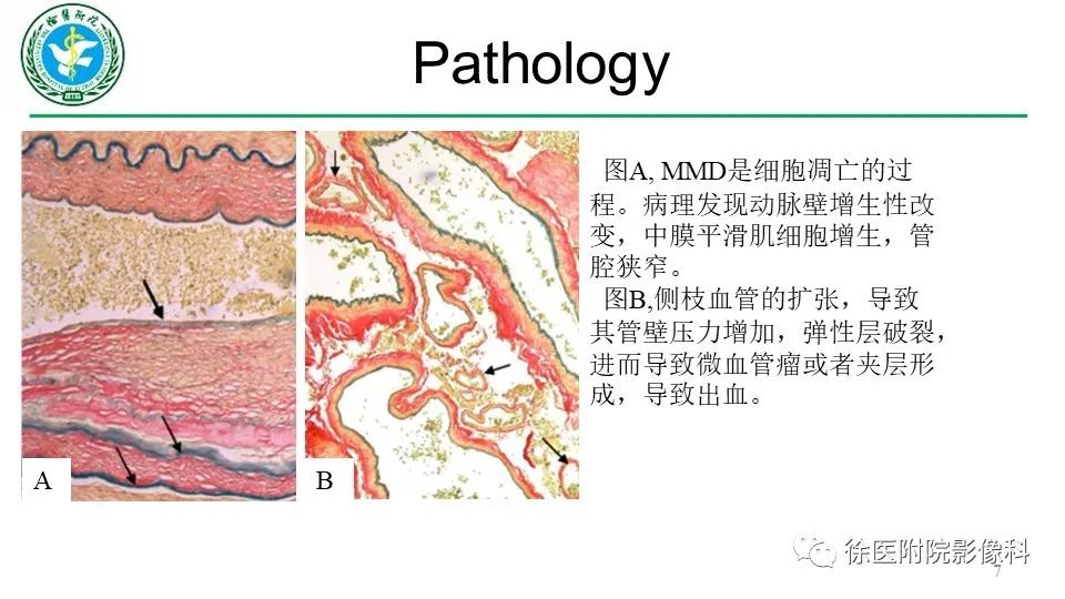 影像PPT - 【PPT】烟雾病和烟雾综合征-7