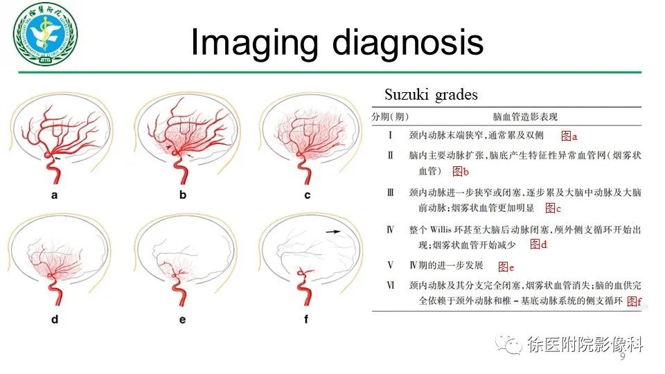 影像PPT - 【PPT】烟雾病和烟雾综合征-9