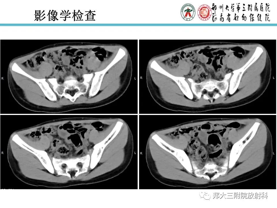 影像PPT - 【PPT】梅克尔憩室-3