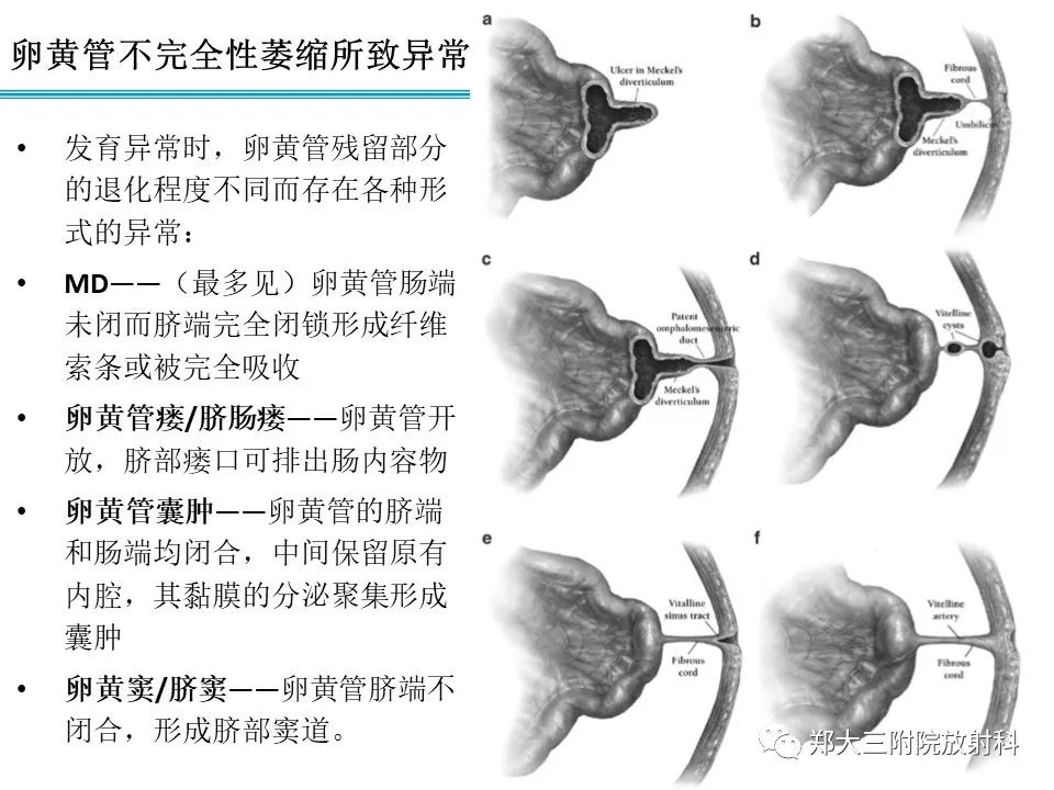 影像PPT - 【PPT】梅克尔憩室-6