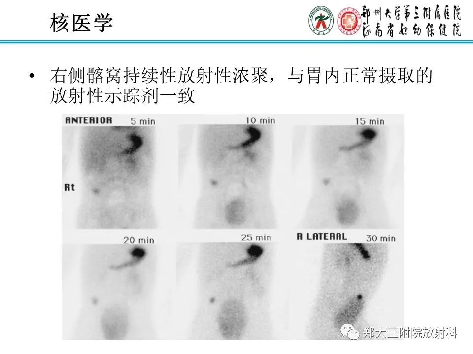 影像PPT - 【PPT】梅克尔憩室-10