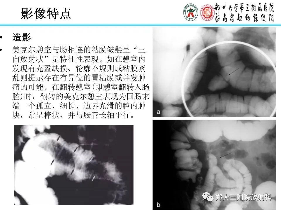 影像PPT - 【PPT】梅克尔憩室-12