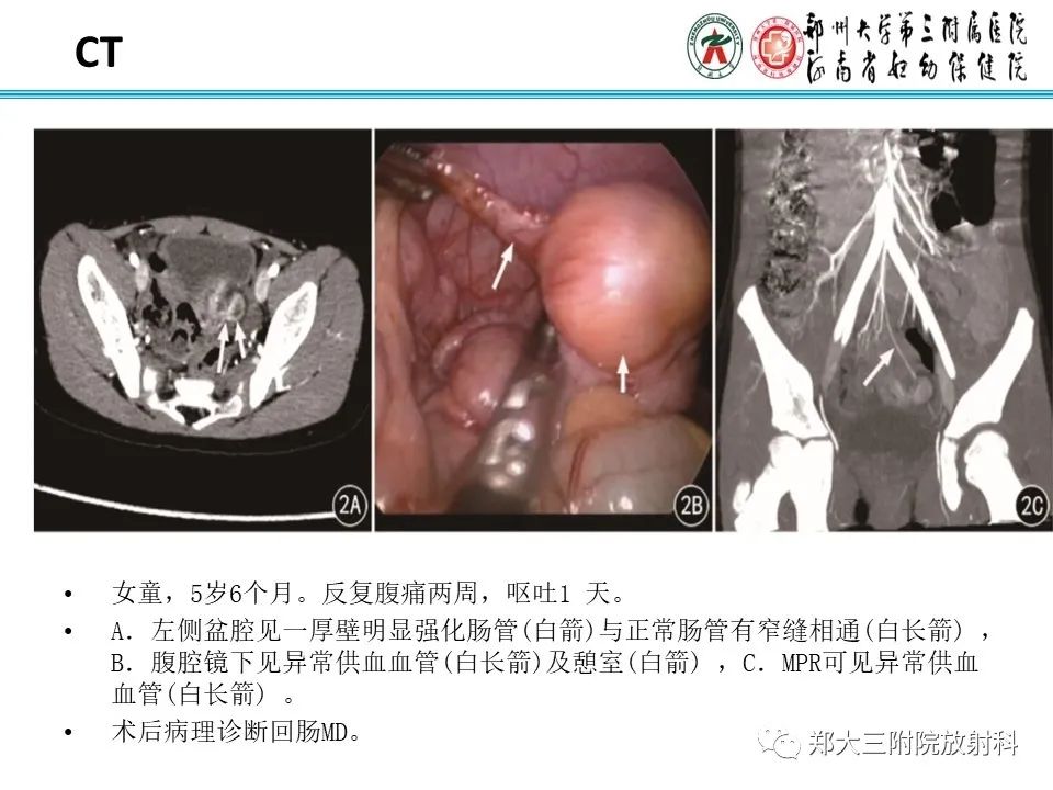 影像PPT - 【PPT】梅克尔憩室-15