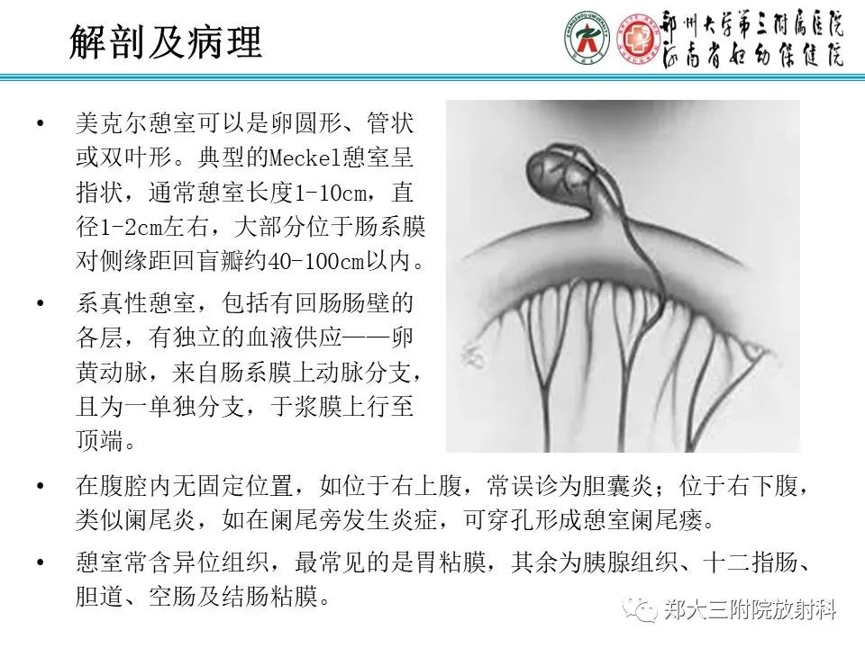 影像PPT - 【PPT】梅克尔憩室-19