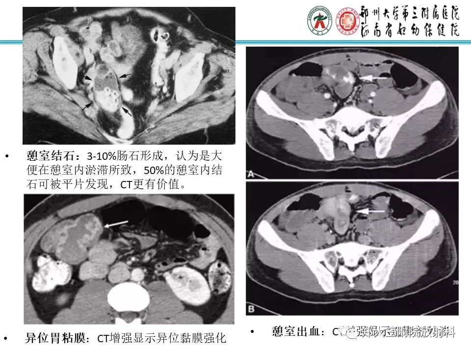 影像PPT - 【PPT】梅克尔憩室-20