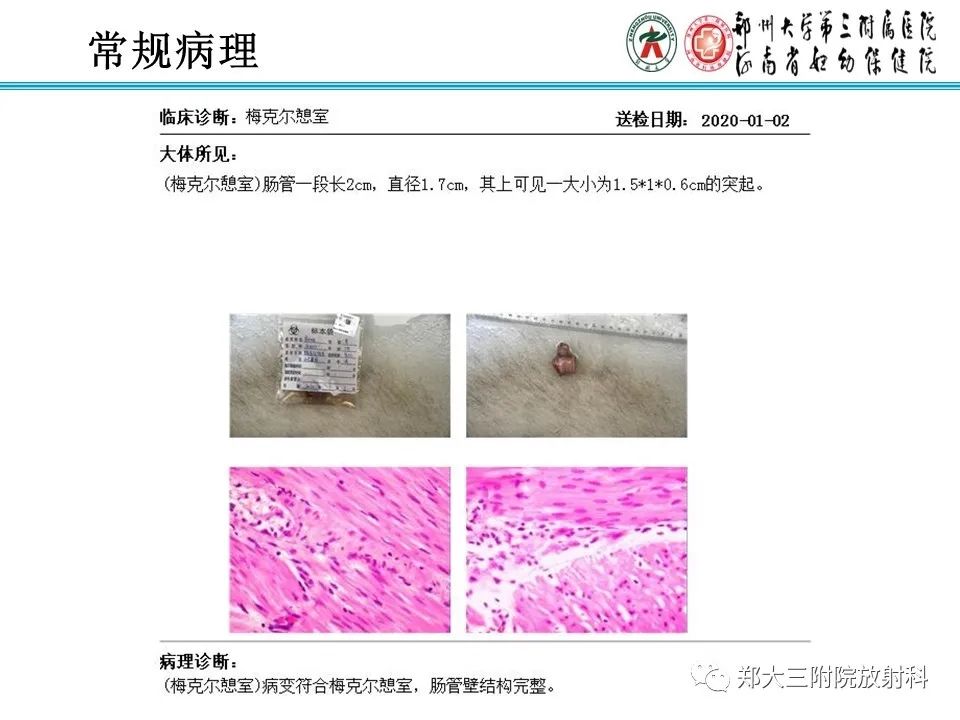 影像PPT - 【PPT】梅克尔憩室-17