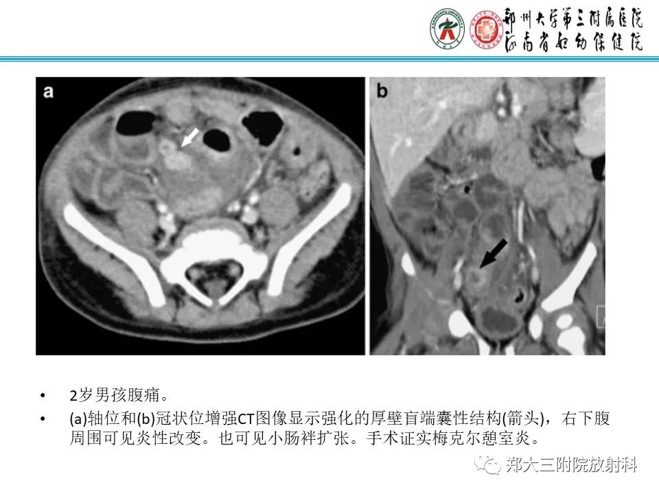 影像PPT - 【PPT】梅克尔憩室-22