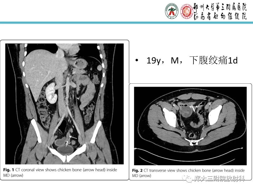 影像PPT - 【PPT】梅克尔憩室-24