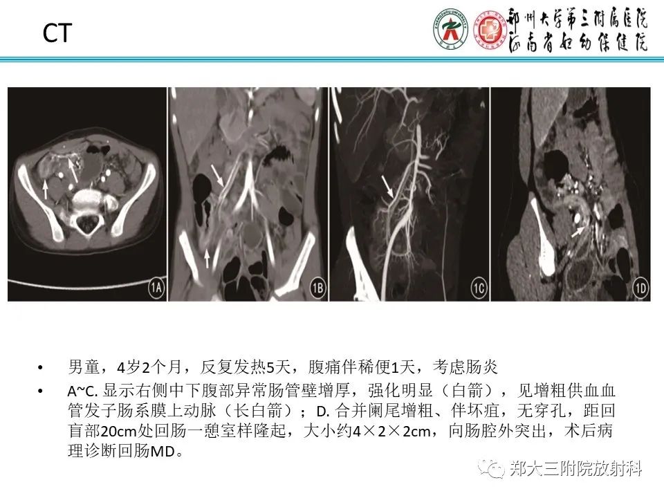 影像PPT - 【PPT】梅克尔憩室-16