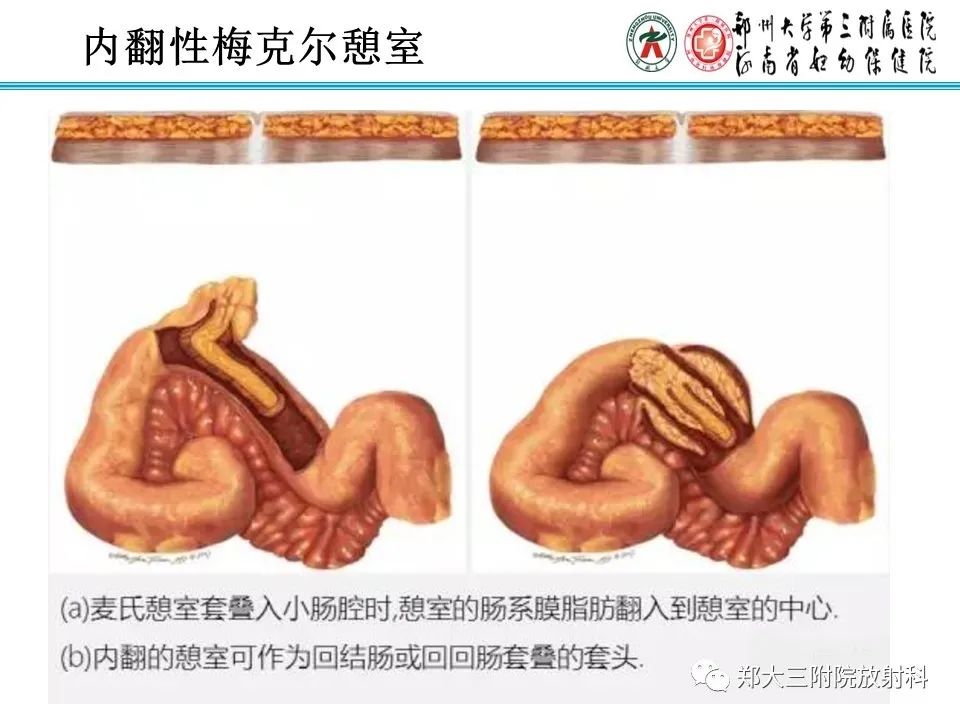 影像PPT - 【PPT】梅克尔憩室-25