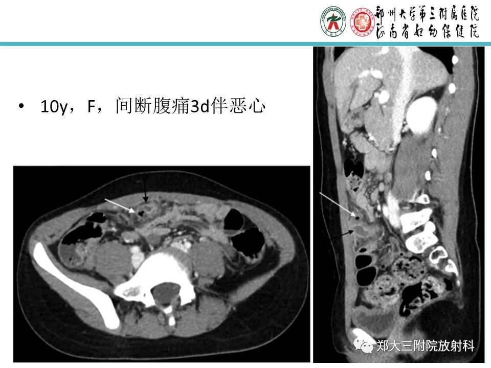 影像PPT - 【PPT】梅克尔憩室-23