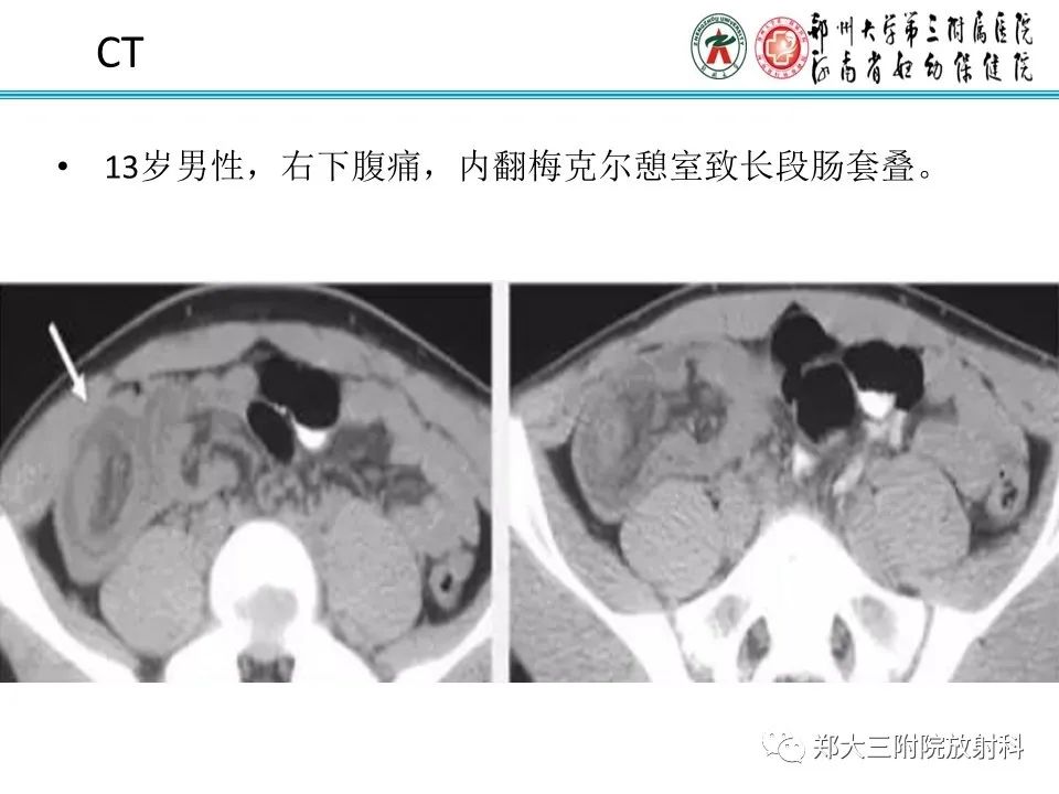 影像PPT - 【PPT】梅克尔憩室-27
