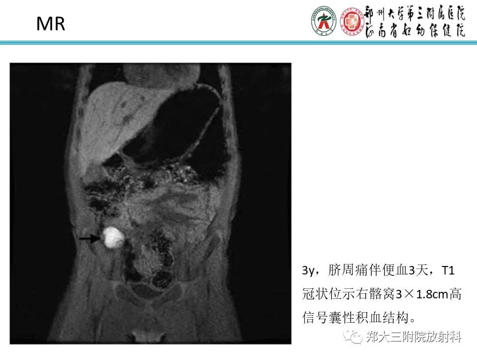 影像PPT - 【PPT】梅克尔憩室-30