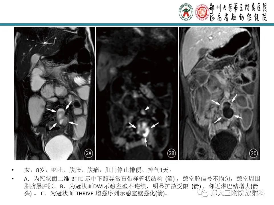 影像PPT - 【PPT】梅克尔憩室-32
