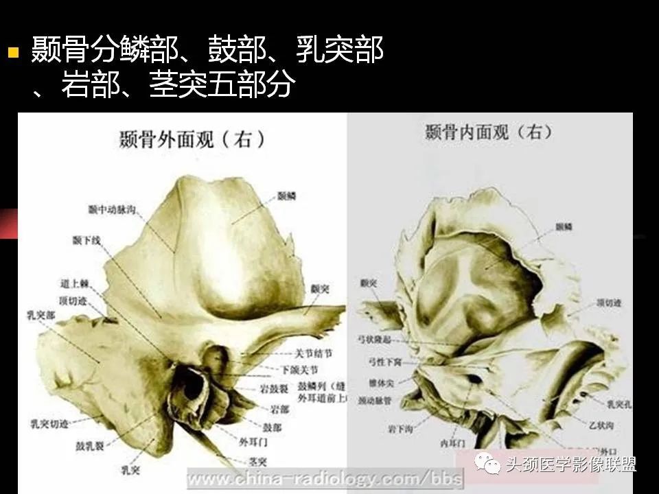 影像PPT - 【PPT】中耳乳突解剖及常见疾病-2