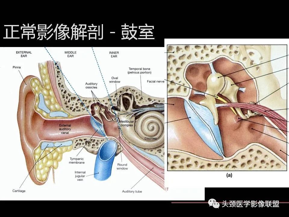 影像PPT - 【PPT】中耳乳突解剖及常见疾病-9